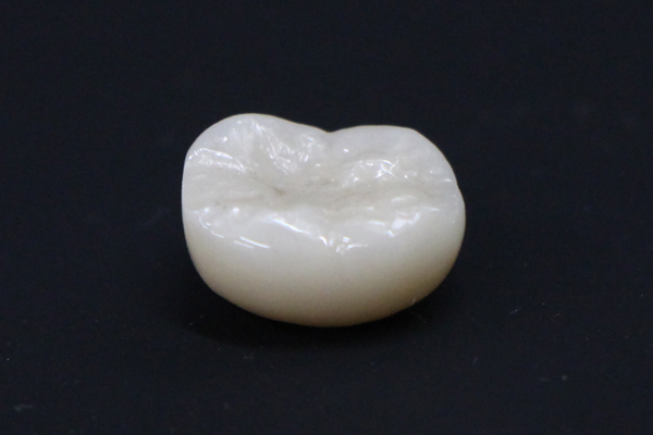 オールセラミックスクラウン