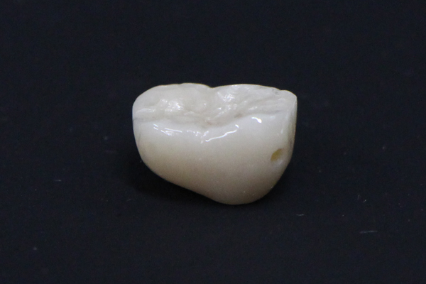 オールセラミックスクラウン