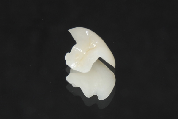 セラミックスインレー（小臼歯）