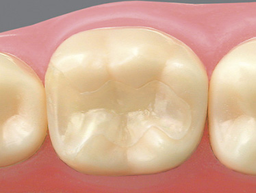 セラミックスインレー（大臼歯）