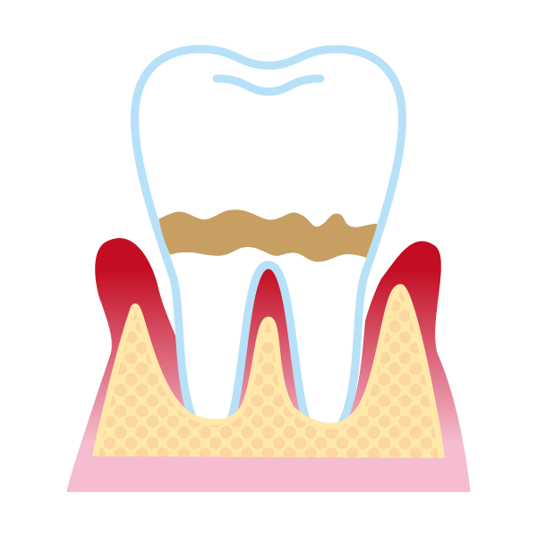 歯周炎（軽度）