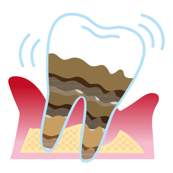 歯周炎（重度）